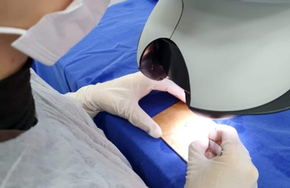 Hospital de Olhos traz equipe de referência em implante capilar